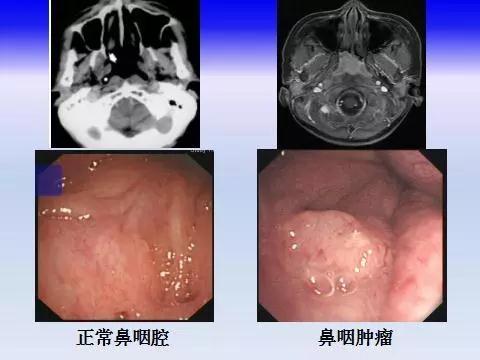 鼻咽肿物照片图片