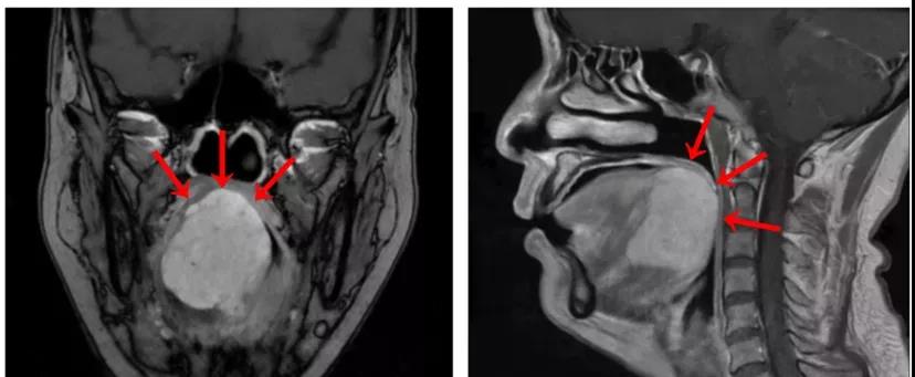 舌癌核磁共振报告图片图片